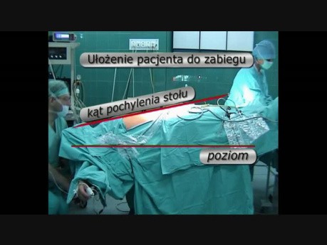 Ułożenie pacjenta - laparoskopowa radykalna prostatektomia