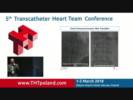 Transcaval Acces for TAVI