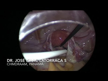Wykorzystanie laparoskopii przy zakładaniu cewnika Tenckhoffa