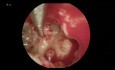 Operacja perlaka (endoskopowa i mikroskopowa)