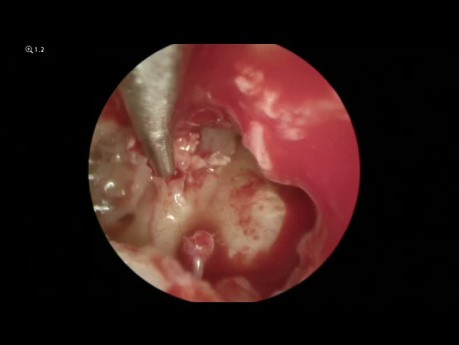 Operacja perlaka (endoskopowa i mikroskopowa)