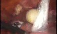 Leczenie laparoskopowe obustronnej torbieli skórzastej jajnika