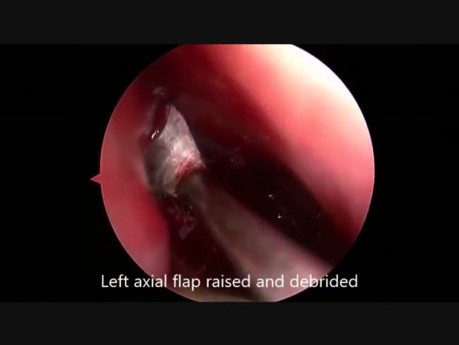 Guz lewej zatoki czołowej - Zmodyfikowana endoskopowa operacja Lothropa (Draf III) (ZEOL)