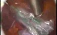 Owariektomia laparoskopowa z powodu torbieli skórzastej
