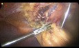 Laroskopowa cholecystektomia z poprzednioą operacją górnej części przewodu pokarmowego