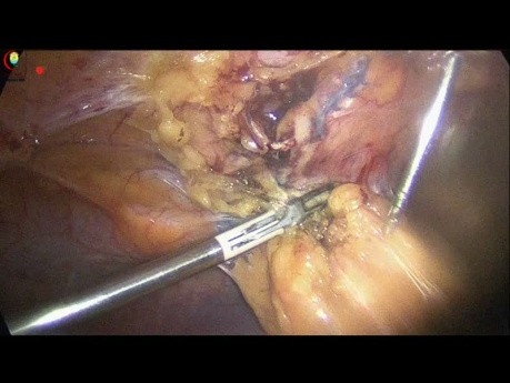 Laroskopowa cholecystektomia z poprzednioą operacją górnej części przewodu pokarmowego