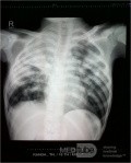 Gruźlica - zdjęcie rentgenowskie