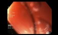 Rozlany skurcz przełyku - "przełyk korkociągowaty" w badaniu endoskopowym