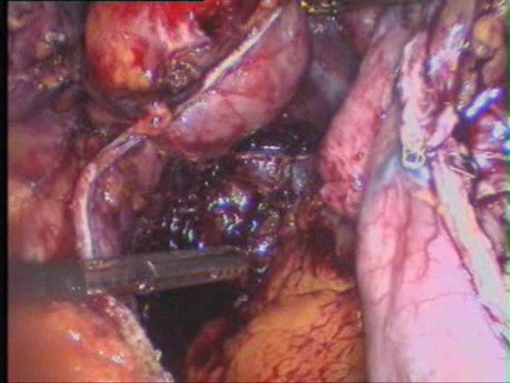 Konwersja z pionowej opaskowej plastyki żołądka (VBG) do resekcji rękawkowej żołądka