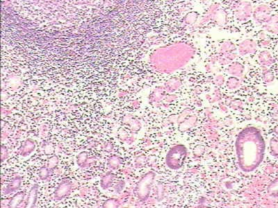 Gruczolakorak wpustu i dna żołądka z komórkami sygnetowatymi (18 z 25)