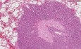 Przerzutowy gruczolakorak - histopatologia - płuco