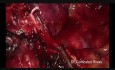 Wideotrakoskopowe usunięcie płata górnego płuca prawego z pojedynczego cięcia pod wyrostkiem mieczykowatym