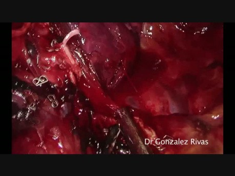 Wideotrakoskopowe usunięcie płata górnego płuca prawego z pojedynczego cięcia pod wyrostkiem mieczykowatym