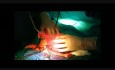 Profilaktyczna salpingektomia podczas cięcia cesarskiego