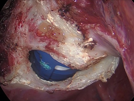 Mięśniaki macicy - całkowita histerektomia laparoskopowa