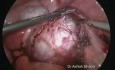 Duża torbiel jajnika - zabieg laparoskopowy