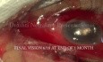 Zaopatrzenie urazowego wewnątrzgałkowego zapalenia oka