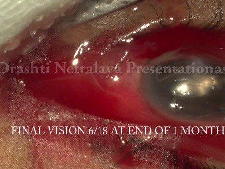 Zaopatrzenie urazowego wewnątrzgałkowego zapalenia oka