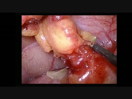 Appendektomia laparoskopowa przy odwróceniu trzewi