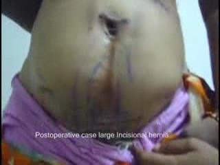 Duża przepuklina w bliźnie pooperacyjnej - stan po hernioplastyce