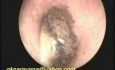 Infekcja grzybicza ucha (otomykoza)