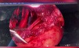 Usuwanie ognisk endometriozy z odbytnicy techniką rectal shaving i histerektomia z powodu endometriozy