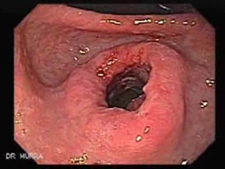 Rak żołądka - metaplazja jelitowa - endoskopia (5 z 7)