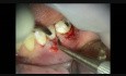 Mikrochirurgia periodontologiczna: przeszczep i naprawa zerwanego płata