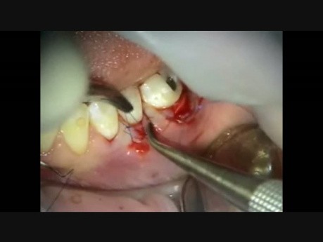 Mikrochirurgia periodontologiczna: przeszczep i naprawa zerwanego płata