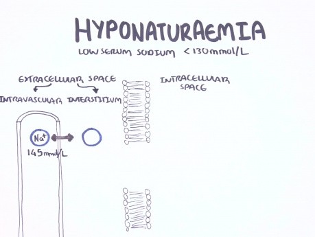 Hiponatremia - klasyfikacja, przyczyny, patofizjologia, postępowanie