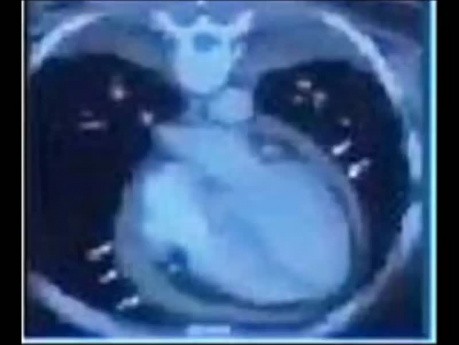 Zaciskające zapalenie osierdzia - ECHO, diagnoza, leczenie