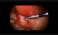 Pyloromiotomia laparoskopowa