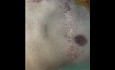 Necessity of Chest Wall Reconstruction for Impediment of Further Trauma 