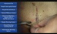 Techniki szycia chirurgicznego - szew materacowy 