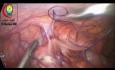Laparoskopowa appendektomia przy użyciu diatermii bipolarnej