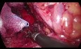 Laparoskopowe odbarczenie pnia trzewnego - zespół więzadła łukowatego pośrodkowego