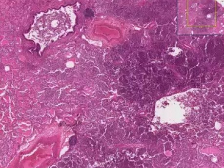 Odoskrzelowe zapalenie płuc z mikroropniami - obraz kliniczny i histopatologiczny
