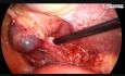 Wymagająca cholecystektomia laparoskopowa