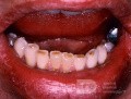 Ścieranie zębów