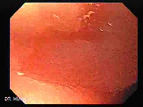 Pneumatyczna dylatacja przełyku - obecność mnogich owrzodzeń i pseudouchyłka