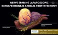 Laparoskopowa prostatektomia pozotrzewnowa z oszczędzaniem nerwów