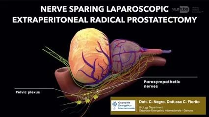 Laparoskopowa prostatektomia pozotrzewnowa z oszczędzaniem nerwów