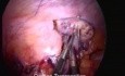 Laparoskopowe przemieszczenie jajników przed radioterapią
