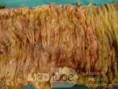 Toxic Dilatation of the Colon Superimposed pseudomembranous colitis involving the right colon (17 of 17)