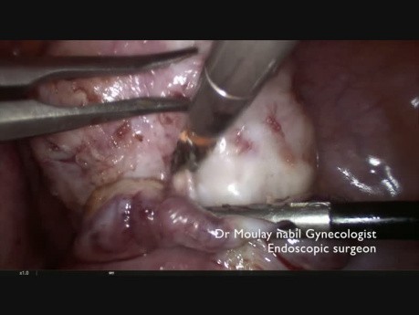 Miomektomia laparoskopowa - tips & tricks