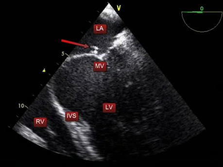 Echo serca przezprzełykowe (TEE) - niewielka wegetacja zastawki mitralnej w przebiegu IZW
