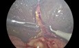 Laparoskopowa portoenterostomia Kasai w atrezji dróg żółciowych u 72-dniowego chłopca