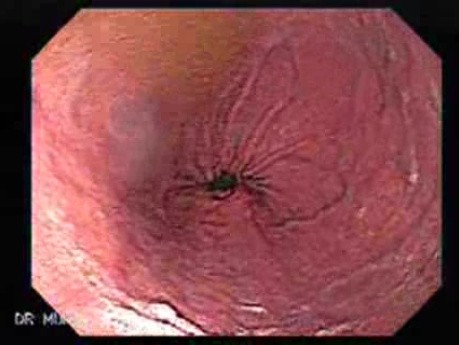Endoskopowy obraz żołądka klepsydrowatego, część 1
