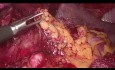 Laparoskopowa gastrektomia z limfadenektomią D2 - kluczowe etapy operacji