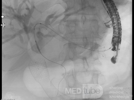 Endoskopowa hepaticogastrostomia pod kontrolą EUS [8/10]